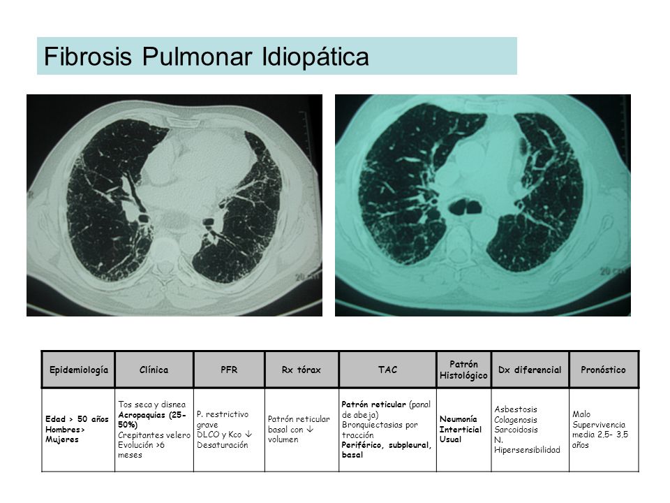 Fibrosis Pulmonar Idiopática