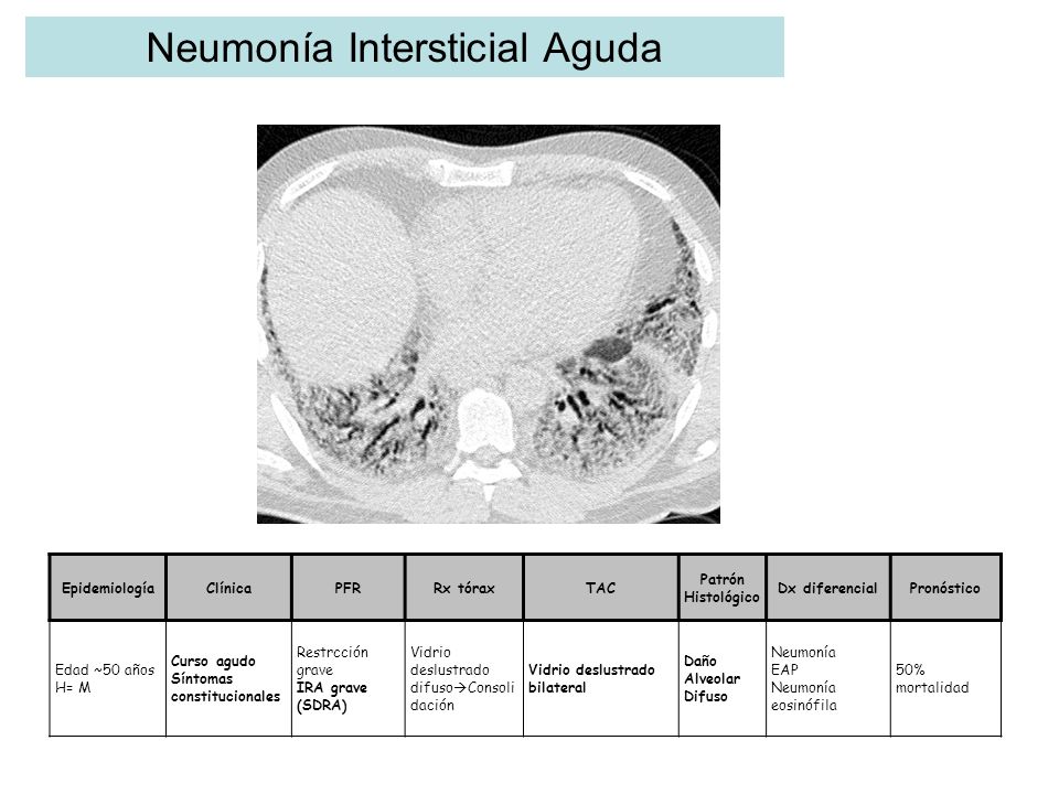 Neumonía Intersticial Aguda