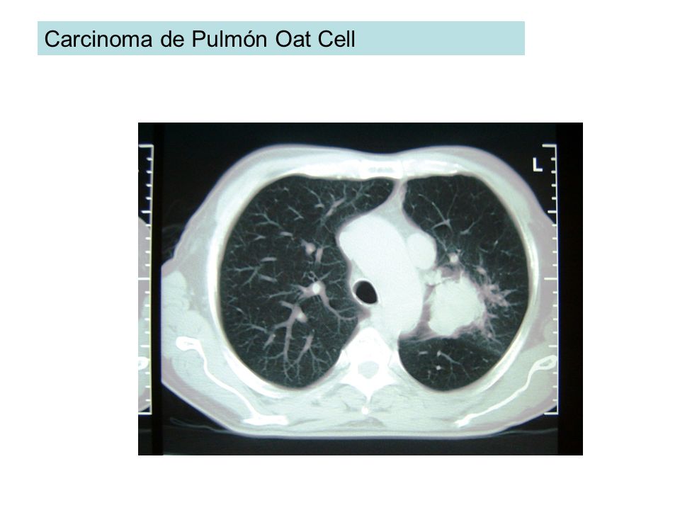 Carcinoma de Pulmón Oat Cell