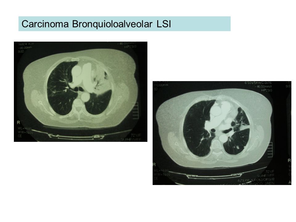 Carcinoma Bronquioloalveolar LSI