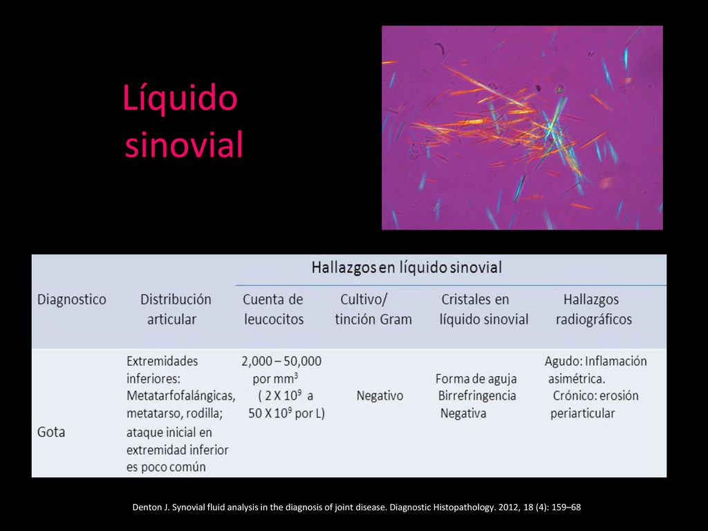 Líquido sinovial Denton J. Synovial fluid analysis in the diagnosis of joint disease.