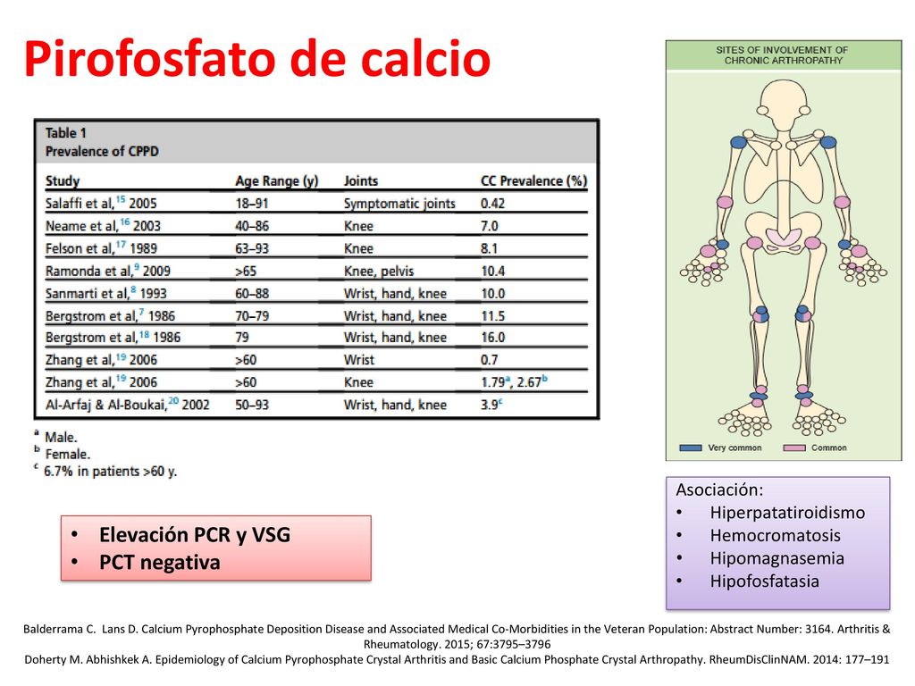 Pirofosfato de calcio Elevación PCR y VSG PCT negativa Asociación: