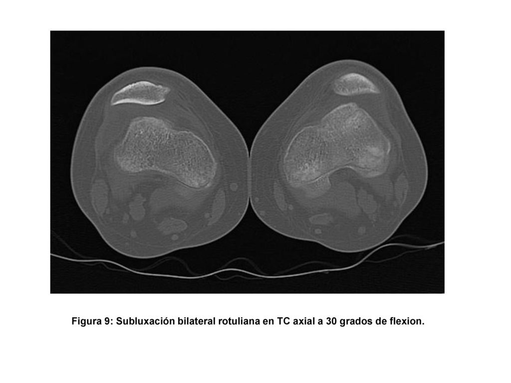 Figura 9: Subluxación bilateral rotuliana en TC axial a 30 grados de flexion.