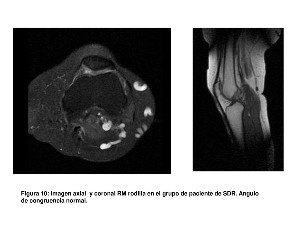 Figura 10: Imagen axial y coronal RM rodilla en el grupo de paciente de SDR.