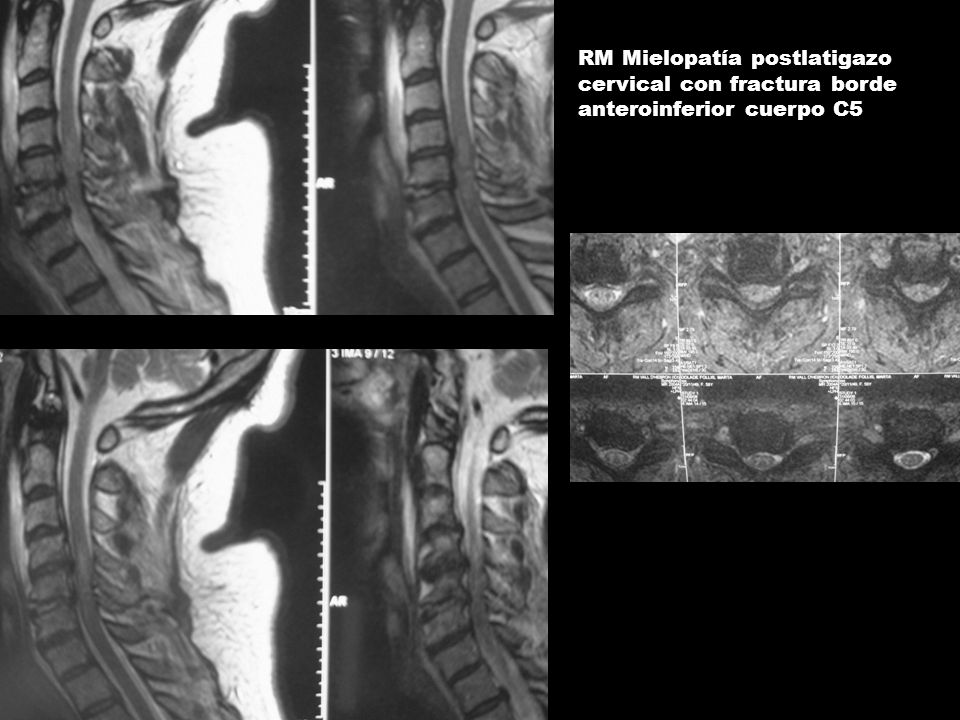 RM Mielopatía postlatigazo cervical con fractura borde anteroinferior cuerpo C5
