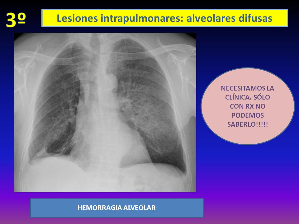 3º Lesiones intrapulmonares: alveolares difusas