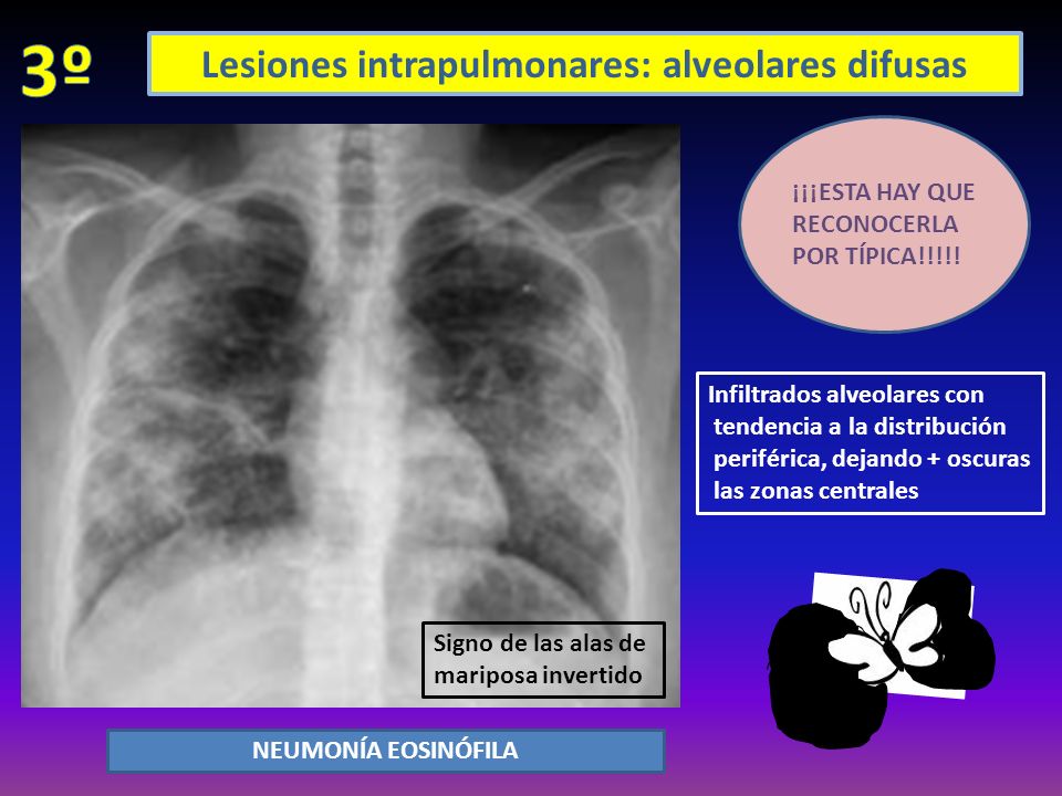 Lesiones intrapulmonares: alveolares difusas