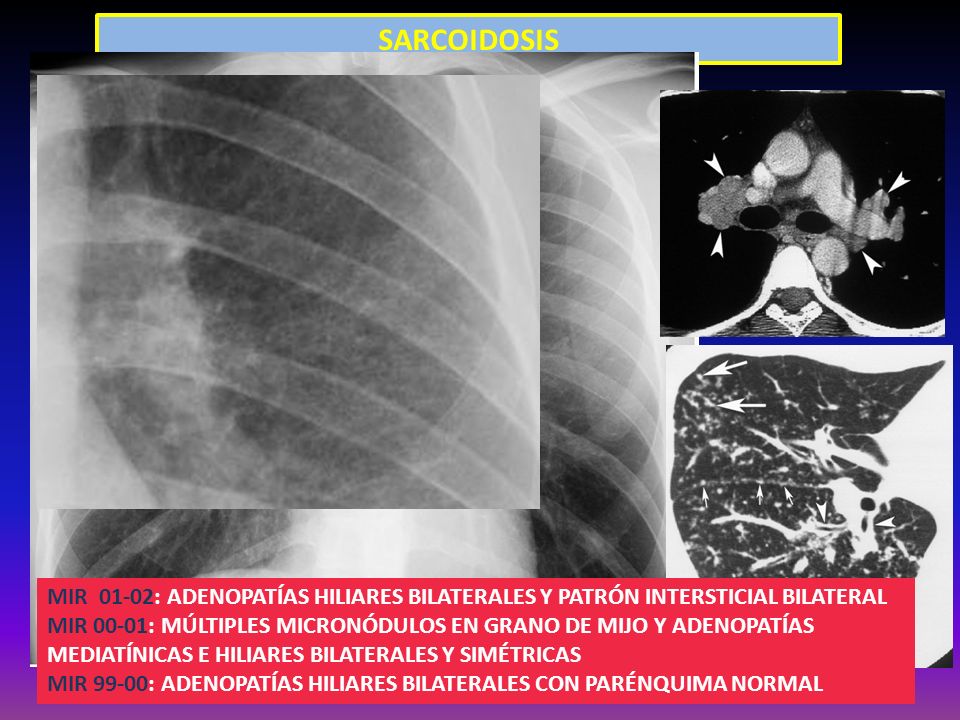 SARCOIDOSIS Figure 5. Pulmonary sarcoidosis in a 24-year-old. man. High-resolution chest CT scan demonstrates.
