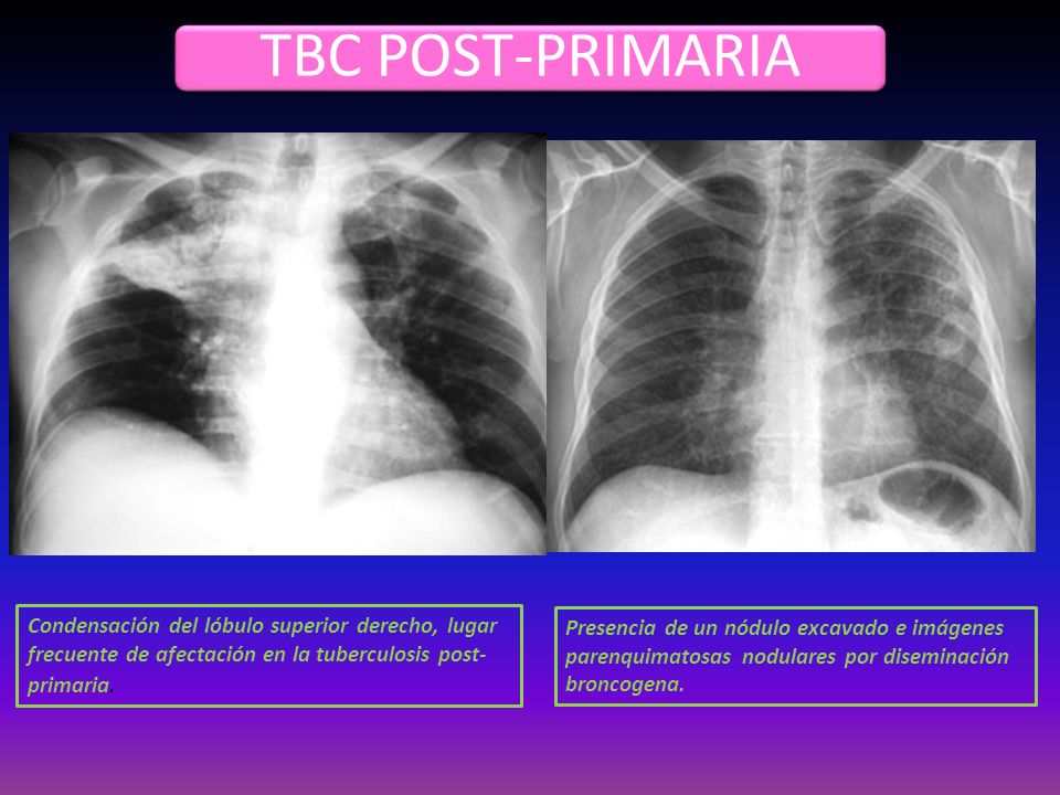 TBC POST-PRIMARIA Condensación del lóbulo superior derecho, lugar frecuente de afectación en la tuberculosis post-primaria.