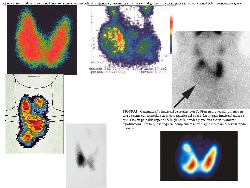 FIGURA1: Gammagrafía funcional de tiroides con Tc-99m en proyección anterior en una paciente con un nódulo en la cara anterior del cuello.