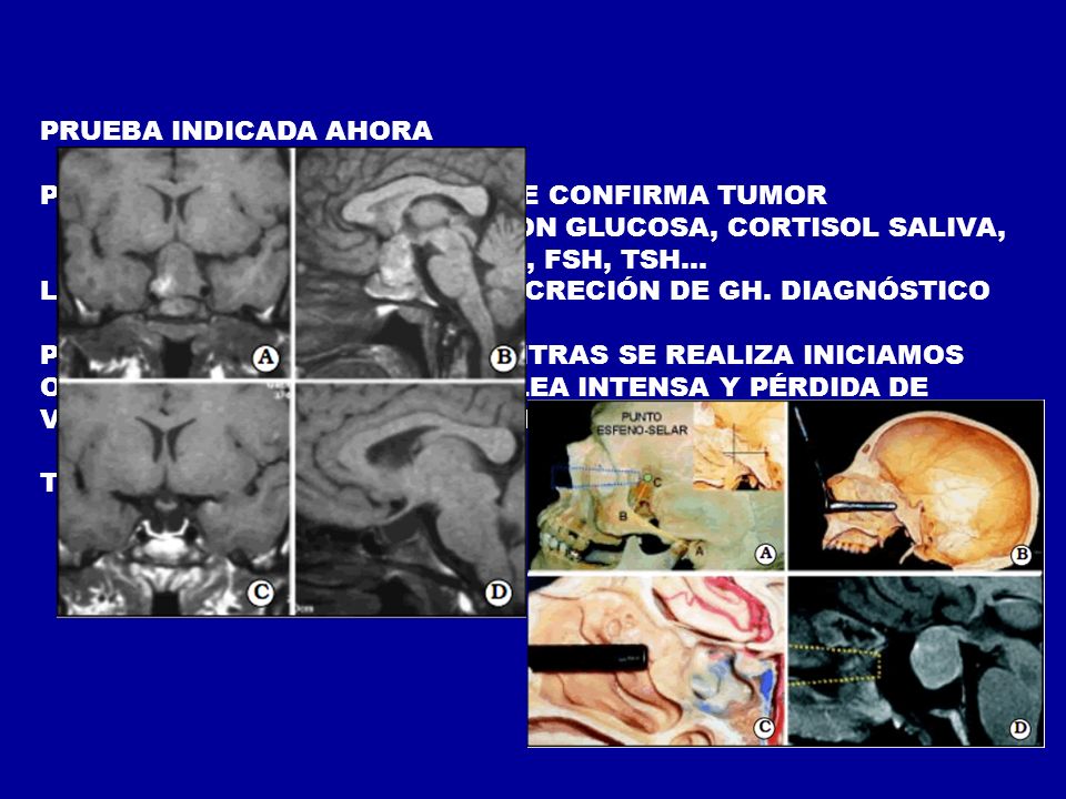 PRUEBA INDICADA AHORA RMN DE SILLA TURCA. PRUEBAS DE LABORATORIO SI SE CONFIRMA TUMOR.