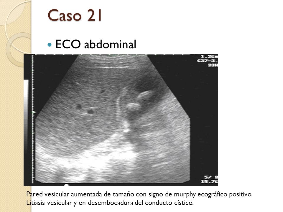 Caso 21 ECO abdominal. Pared vesicular aumentada de tamaño con signo de murphy ecográfico positivo.