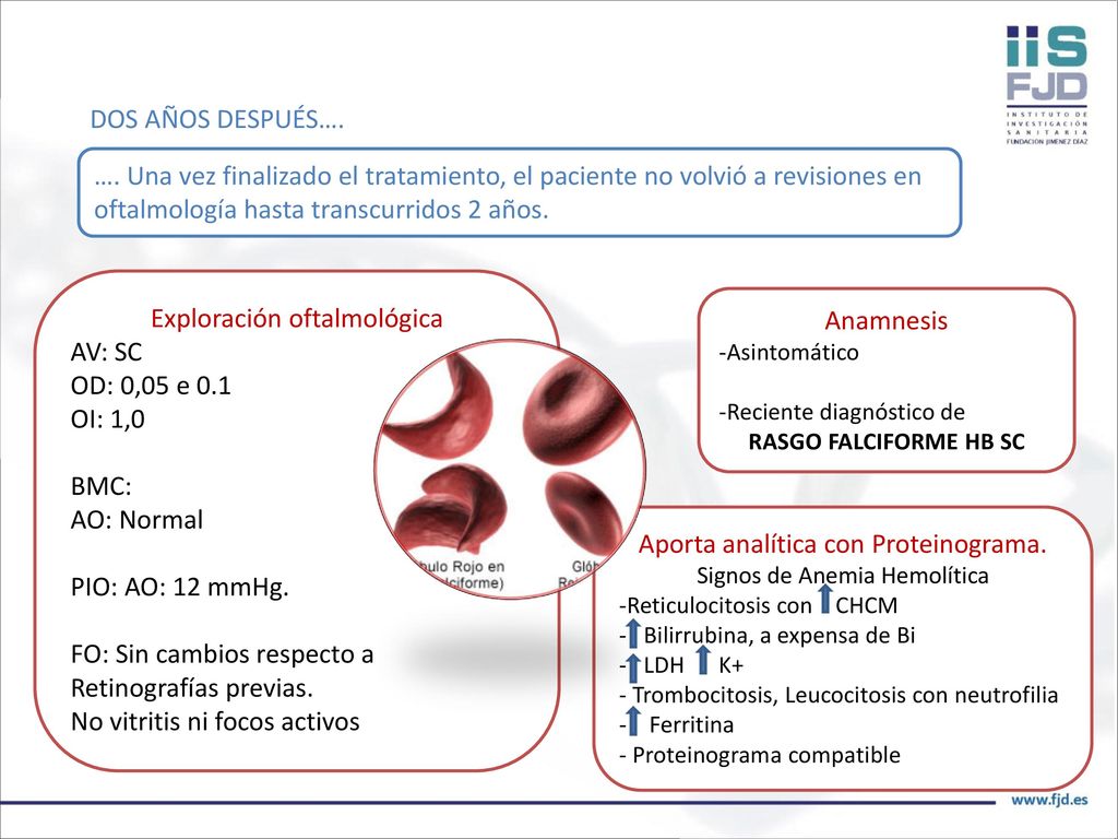 Exploración oftalmológica AV: SC OD: 0,05 e 0.1 OI: 1,0 BMC: