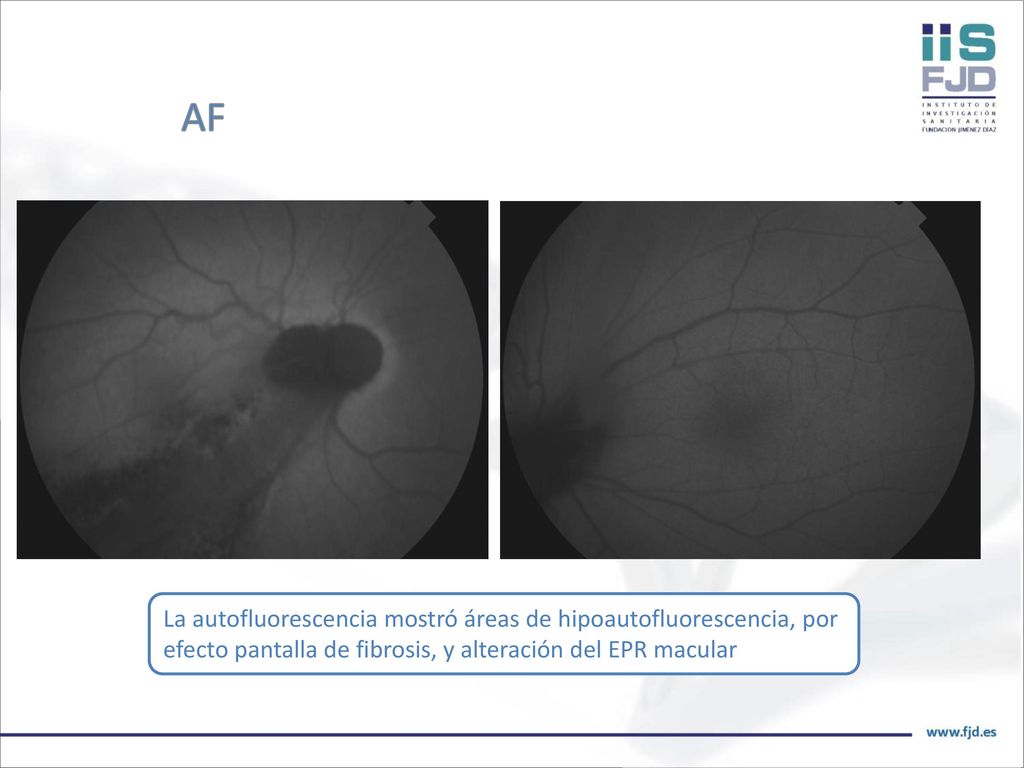 AF La autofluorescencia mostró áreas de hipoautofluorescencia, por efecto pantalla de fibrosis, y alteración del EPR macular.