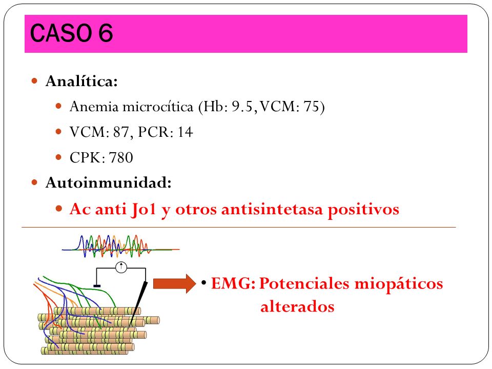 CASO 6 Ac anti Jo1 y otros antisintetasa positivos alterados