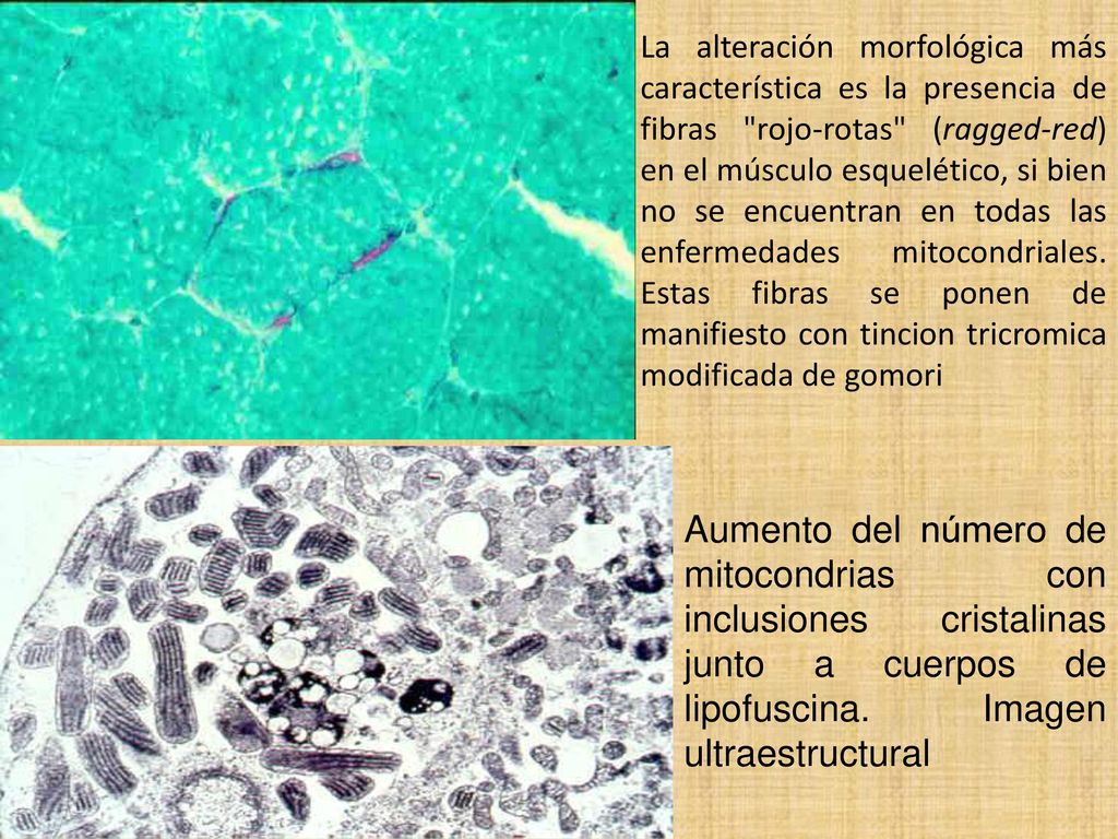 La alteración morfológica más característica es la presencia de fibras rojo-rotas (ragged-red) en el músculo esquelético, si bien no se encuentran en todas las enfermedades mitocondriales. Estas fibras se ponen de manifiesto con tincion tricromica modificada de gomori