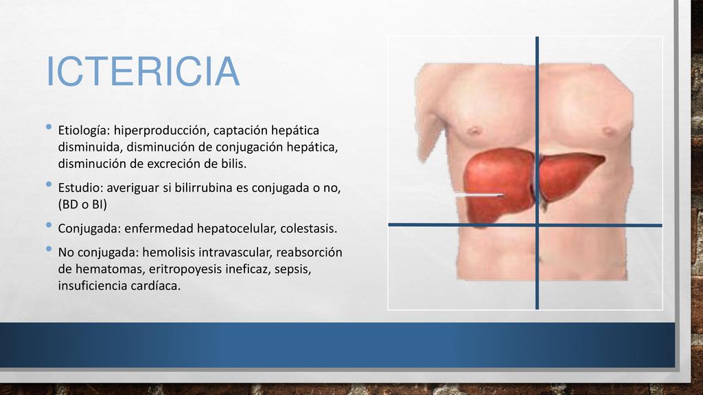 ictericia Etiología: hiperproducción, captación hepática disminuida, disminución de conjugación hepática, disminución de excreción de bilis.