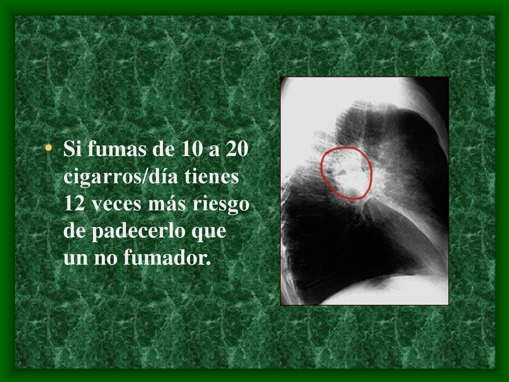 Si fumas de 10 a 20 cigarros/día tienes 12 veces más riesgo de padecerlo que un no fumador.