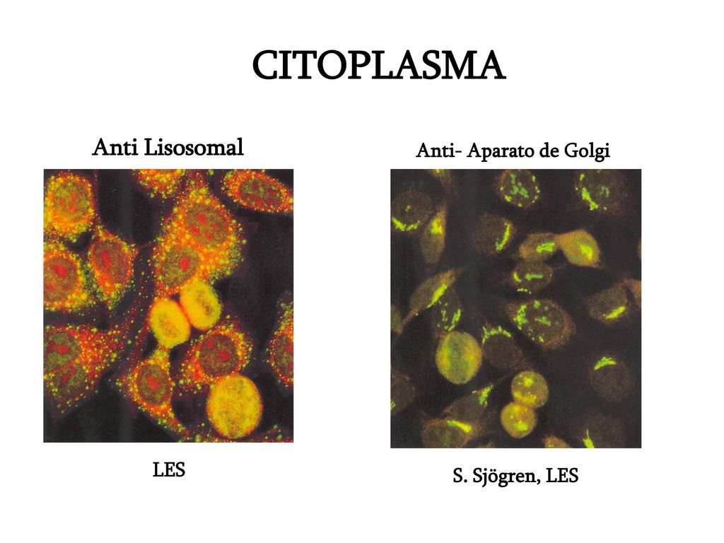 CITOPLASMA Anti Lisosomal Anti- Aparato de Golgi LES S. Sjögren, LES