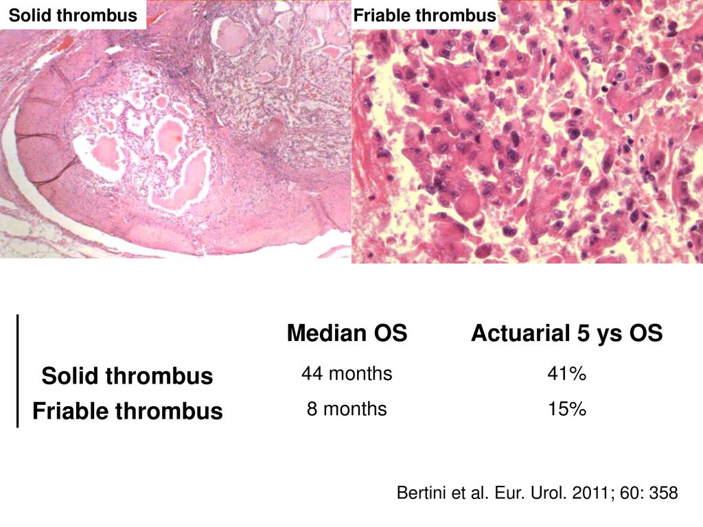Median OS Actuarial 5 ys OS Solid thrombus Friable thrombus