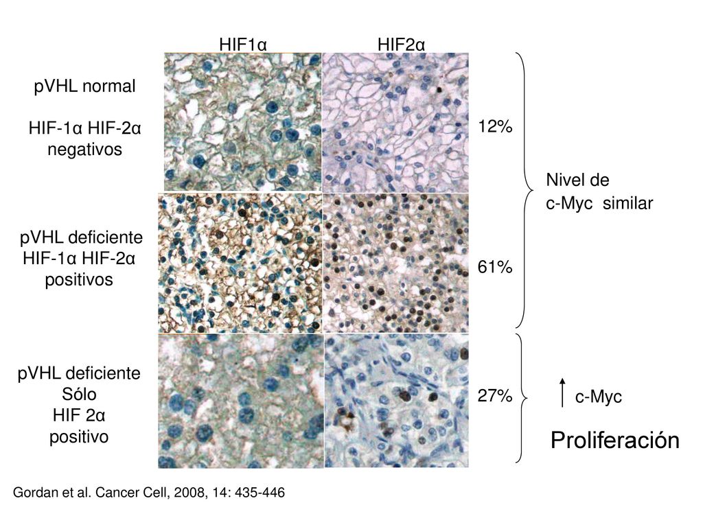Proliferación HIF1α HIF2α pVHL normal HIF-1α HIF-2α negativos 12%