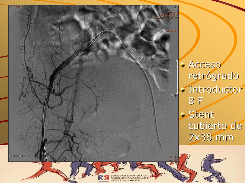 Acceso retrógrado Introductor 8 F Stent cubierto de 7x38 mm
