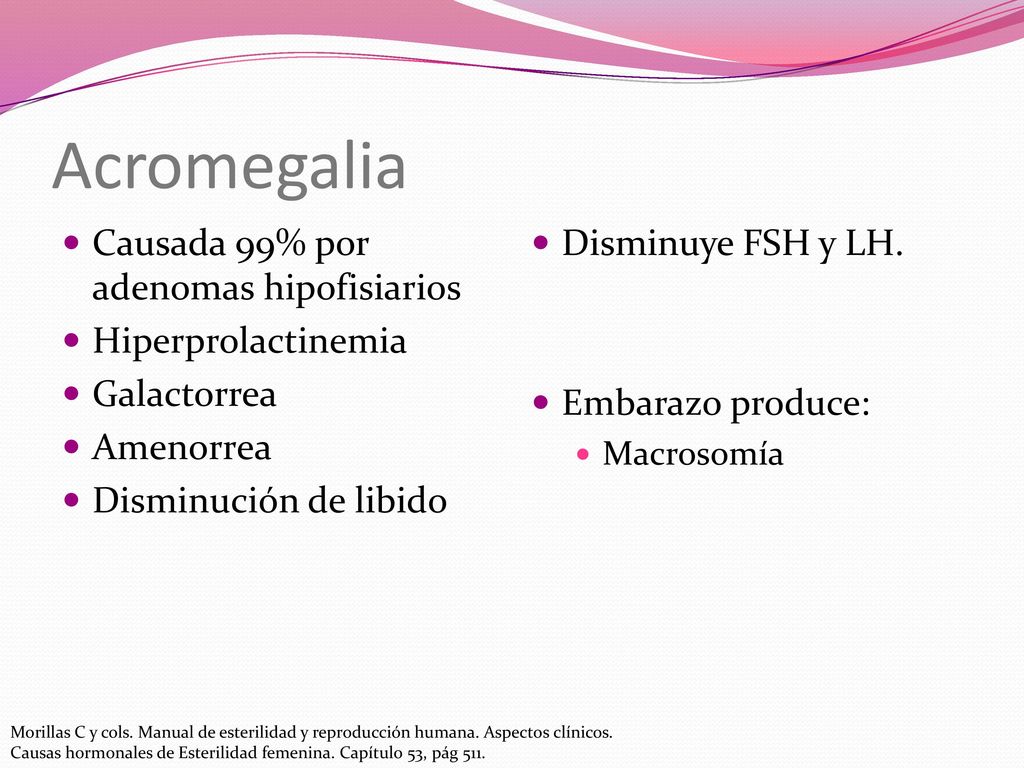 Acromegalia Causada 99% por adenomas hipofisiarios Hiperprolactinemia