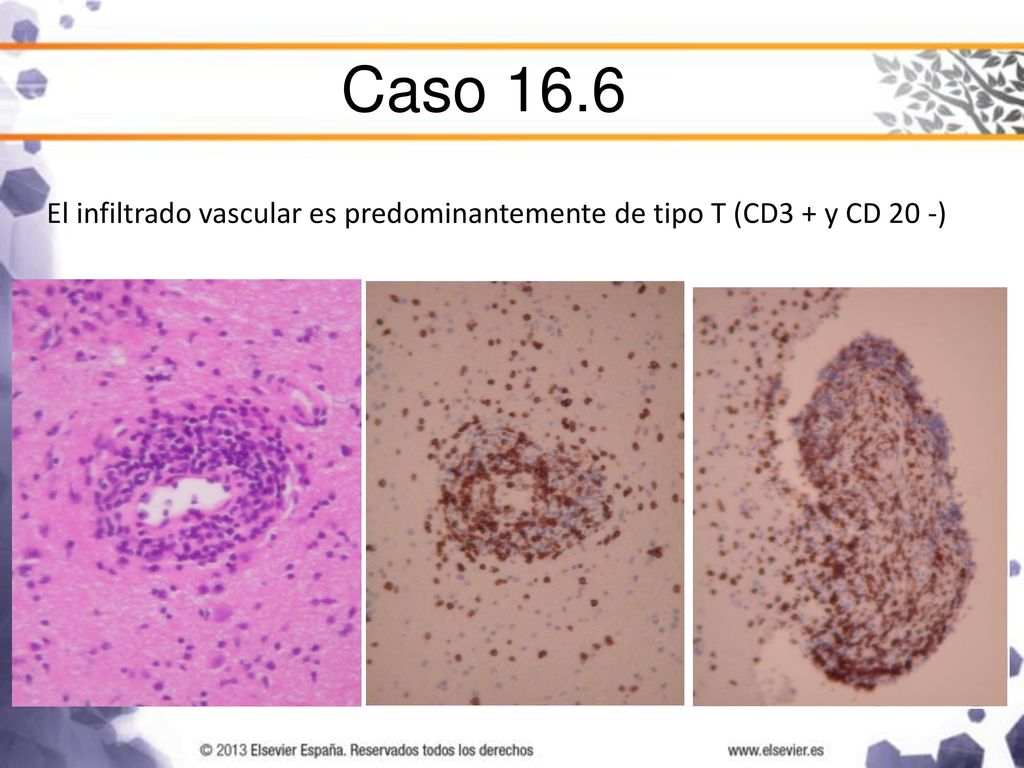 Caso 16.6 El infiltrado vascular es predominantemente de tipo T (CD3 + y CD 20 -)