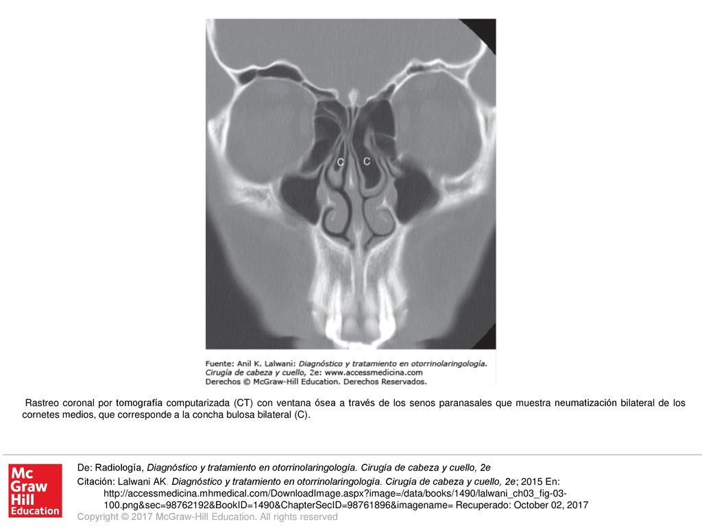 Rastreo coronal por tomografía computarizada (CT) con ventana ósea a través de los senos paranasales que muestra neumatización bilateral de los cornetes medios, que corresponde a la concha bulosa bilateral (C).