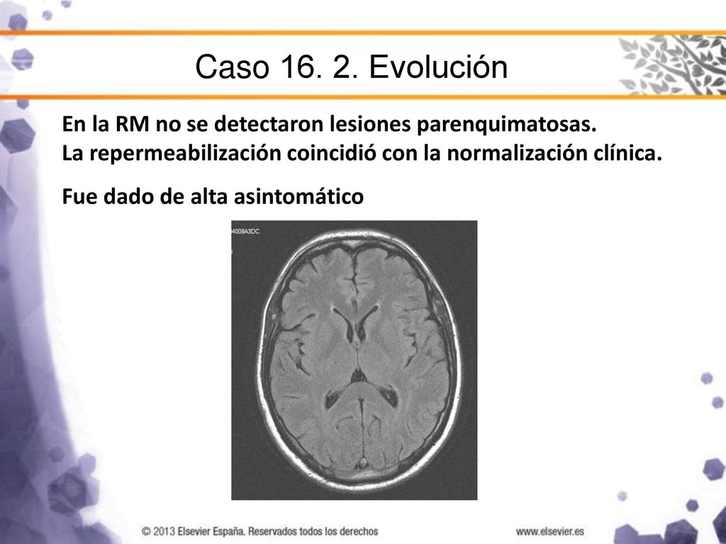 Caso Evolución En la RM no se detectaron lesiones parenquimatosas. La repermeabilización coincidió con la normalización clínica.