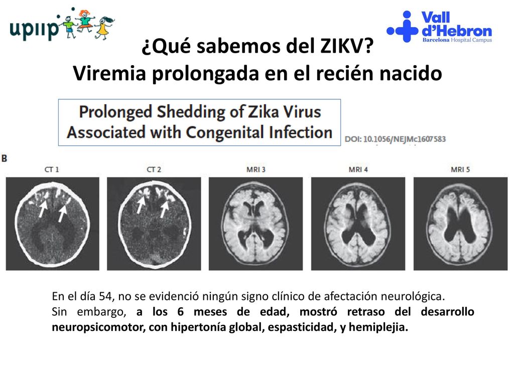 ¿Qué sabemos del ZIKV Viremia prolongada en el recién nacido