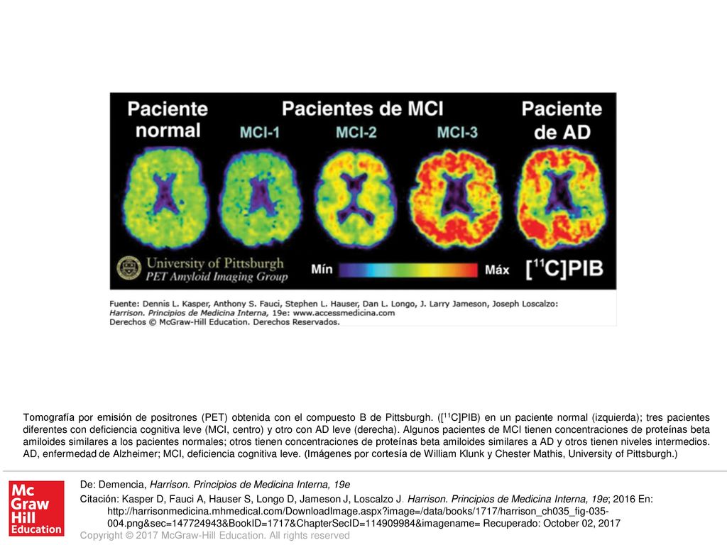 Tomografía por emisión de positrones (PET) obtenida con el compuesto B de Pittsburgh. ([11C]PIB) en un paciente normal (izquierda); tres pacientes diferentes con deficiencia cognitiva leve (MCI, centro) y otro con AD leve (derecha). Algunos pacientes de MCI tienen concentraciones de proteínas beta amiloides similares a los pacientes normales; otros tienen concentraciones de proteínas beta amiloides similares a AD y otros tienen niveles intermedios. AD, enfermedad de Alzheimer; MCI, deficiencia cognitiva leve. (Imágenes por cortesía de William Klunk y Chester Mathis, University of Pittsburgh.)