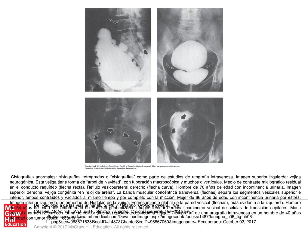 Cistografías anormales: cistografías retrógradas o cistografías como parte de estudios de urografía intravenosa. Imagen superior izquierda: vejiga neurogénica. Esta vejiga tiene forma de árbol de Navidad , con tuberación macroscópica y muchos divertículos. Medio de contraste mielográfico residual en el conducto raquídeo (flecha recta). Reflujo vesicoureteral derecho (flecha curva). Hombre de 70 años de edad con incontinencia urinaria. Imagen superior derecha: vejiga congénita en reloj de arena . La banda muscular concéntrica transversa (flechas) separa los segmentos vesicales superior e inferior, ambos contraídos y vaciados al mismo tiempo y por completo con la micción. Mujer de 66 años de edad con incontinencia urinaria por estrés. Imagen inferior izquierda: enfermedad de Hodgkin de la vejiga. Engrosamiento global de la pared vesical (flechas), más evidente a la izquierda. Hombre de 54 años de edad con enfermedad de Hodgkin generalizada. Imagen inferior derecha: carcinoma vesical de células de transición capilares. Masa vesical enorme (12 cm) con forma de coliflor (flechas) que llena casi toda la vejiga. Cistografía de una urografía intravenosa en un hombre de 40 años de edad con tumor vesical recurrente.