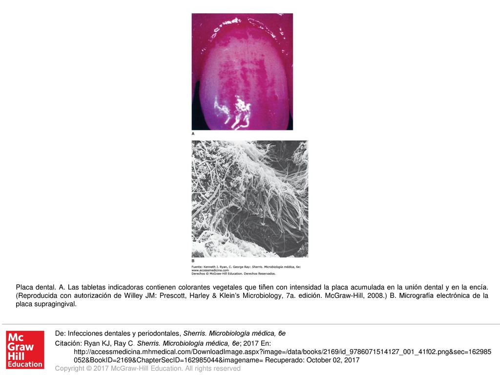 Placa dental. A. Las tabletas indicadoras contienen colorantes vegetales que tiñen con intensidad la placa acumulada en la unión dental y en la encía. (Reproducida con autorización de Willey JM: Prescott, Harley & Klein’s Microbiology, 7a. edición. McGraw-Hill, 2008.) B. Micrografía electrónica de la placa supragingival.