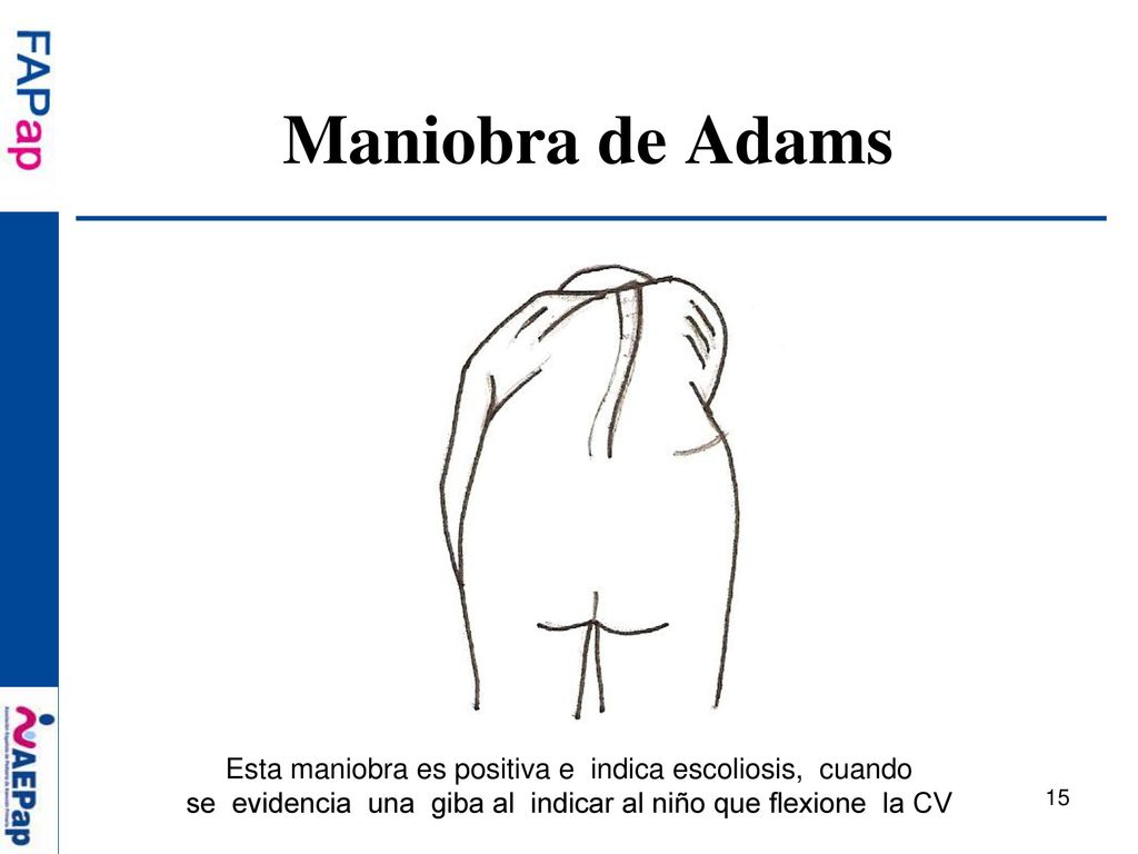 Maniobra de Adams Esta maniobra es positiva e indica escoliosis, cuando.