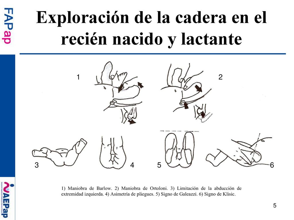 Exploración de la cadera en el recién nacido y lactante
