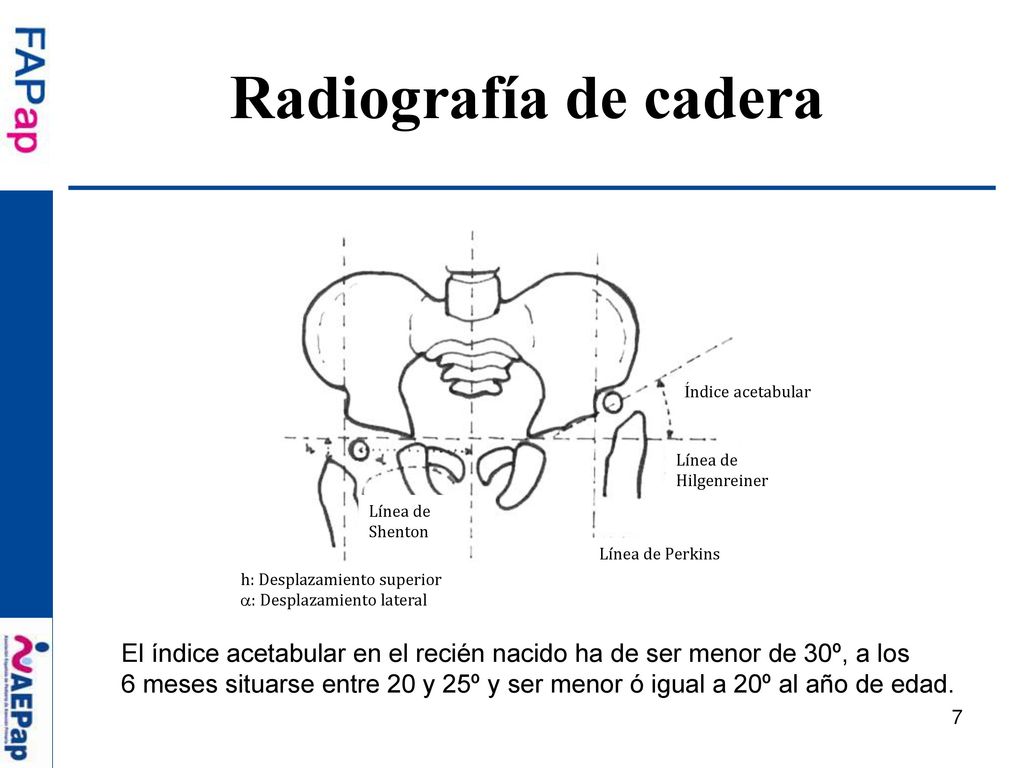 Radiografía de cadera Índice acetabular. Línea de Hilgenreiner. Línea de. Shenton. Línea de Perkins.