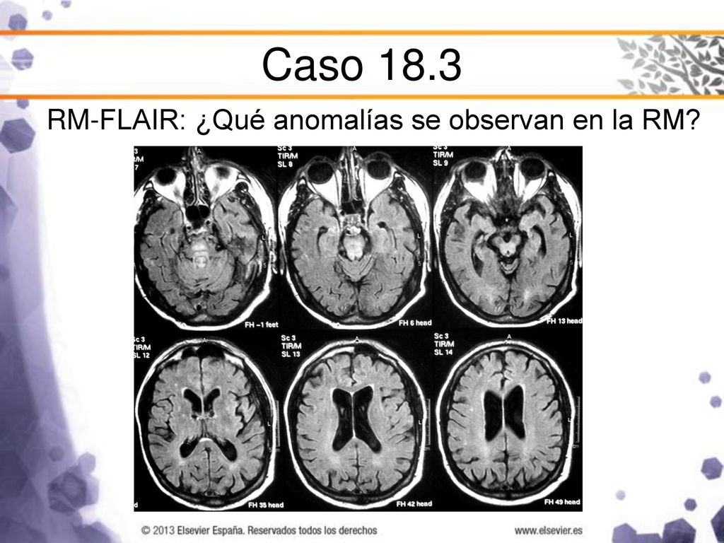 Caso 18.3 RM-FLAIR: ¿Qué anomalías se observan en la RM
