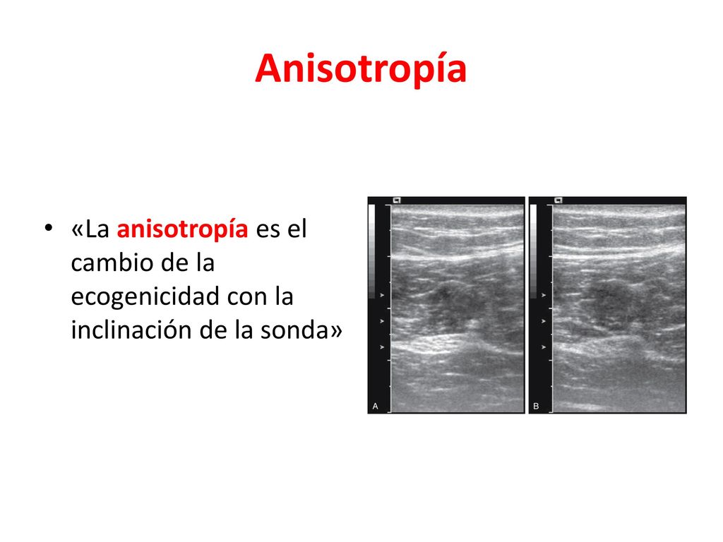 Anisotropía «La anisotropía es el cambio de la ecogenicidad con la inclinación de la sonda»