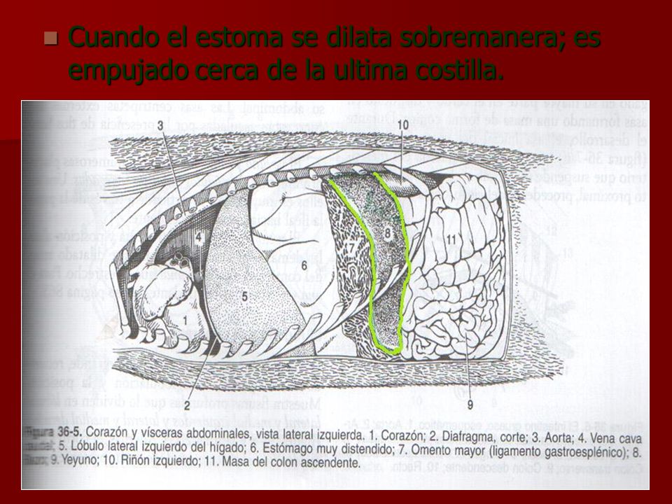 Cuando el estoma se dilata sobremanera; es empujado cerca de la ultima costilla.