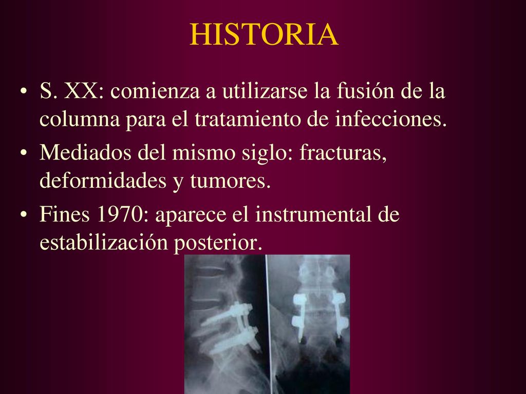 HISTORIA S. XX: comienza a utilizarse la fusión de la columna para el tratamiento de infecciones.