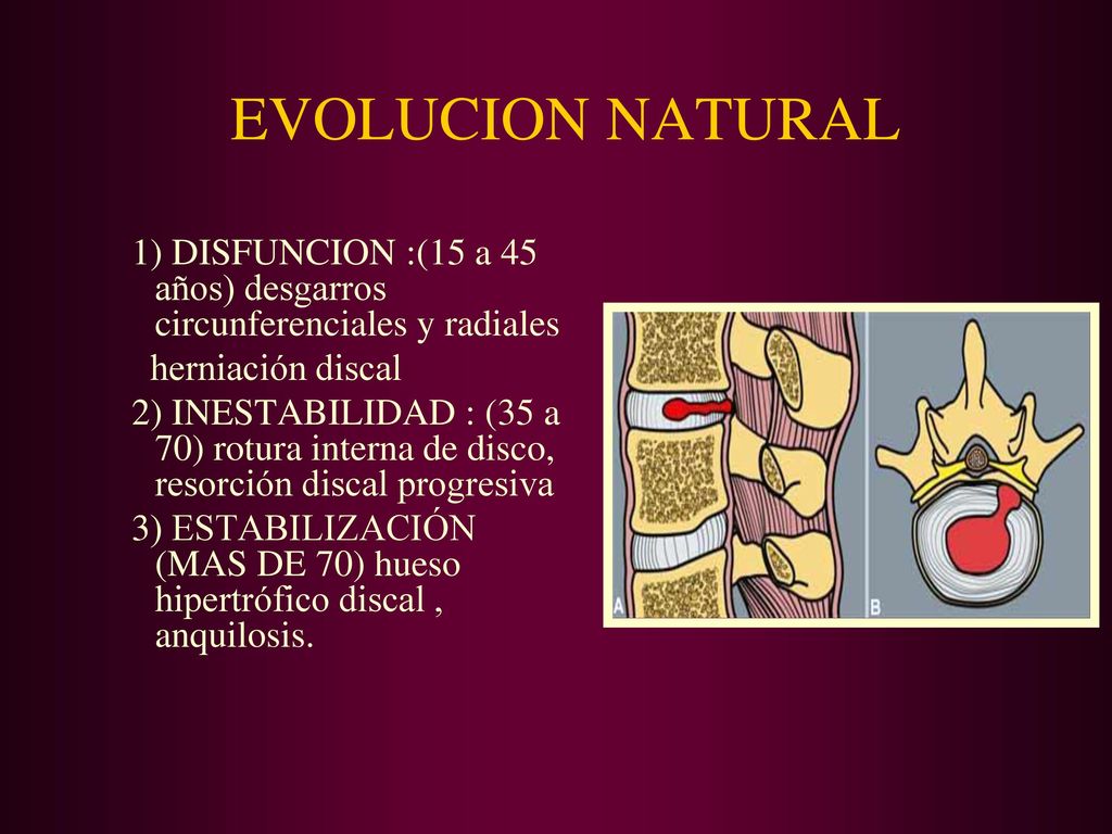 EVOLUCION NATURAL 1) DISFUNCION :(15 a 45 años) desgarros circunferenciales y radiales. herniación discal.