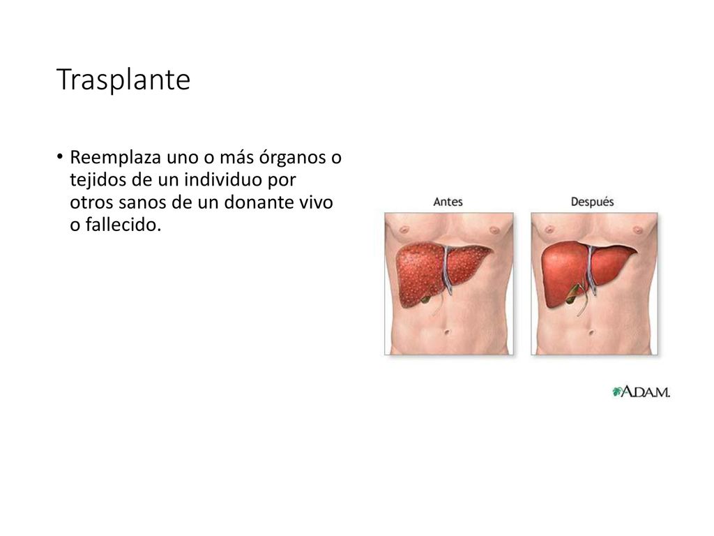 Trasplante Reemplaza uno o más órganos o tejidos de un individuo por otros sanos de un donante vivo o fallecido.