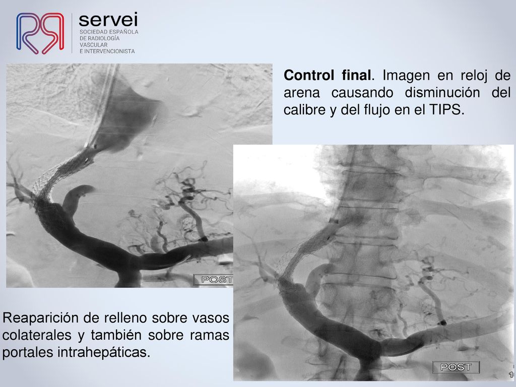 Control final. Imagen en reloj de arena causando disminución del calibre y del flujo en el TIPS.
