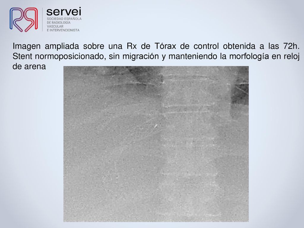 Imagen ampliada sobre una Rx de Tórax de control obtenida a las 72h