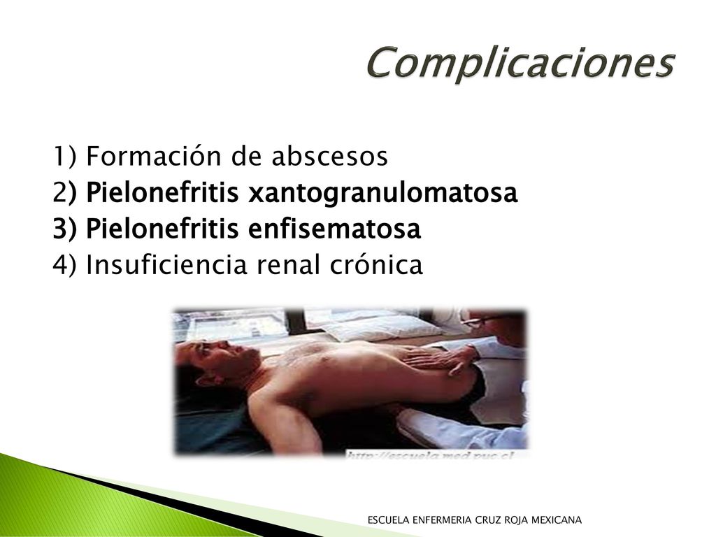 Complicaciones 1) Formación de abscesos 2) Pielonefritis xantogranulomatosa 3) Pielonefritis enfisematosa 4) Insuficiencia renal crónica