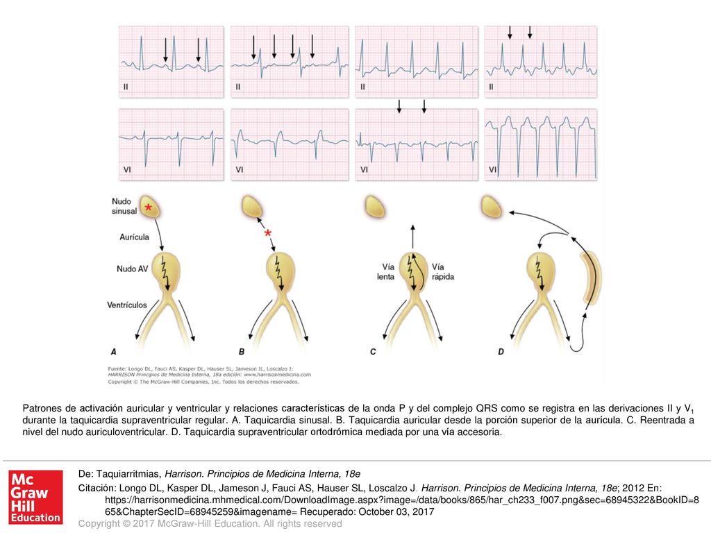 Patrones de activación auricular y ventricular y relaciones características de la onda P y del complejo QRS como se registra en las derivaciones II y V1 durante la taquicardia supraventricular regular. A. Taquicardia sinusal. B. Taquicardia auricular desde la porción superior de la aurícula. C. Reentrada a nivel del nudo auriculoventricular. D. Taquicardia supraventricular ortodrómica mediada por una vía accesoria.