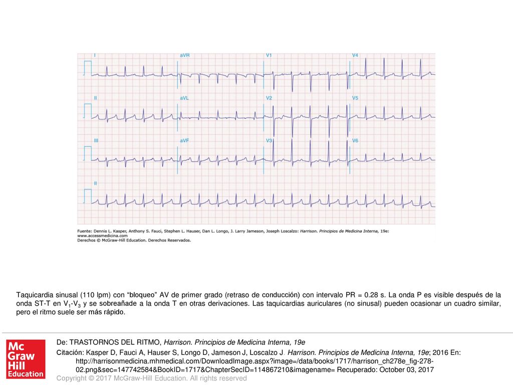 Taquicardia sinusal (110 lpm) con bloqueo AV de primer grado (retraso de conducción) con intervalo PR = 0.28 s. La onda P es visible después de la onda ST-T en V1-V3 y se sobreañade a la onda T en otras derivaciones. Las taquicardias auriculares (no sinusal) pueden ocasionar un cuadro similar, pero el ritmo suele ser más rápido.