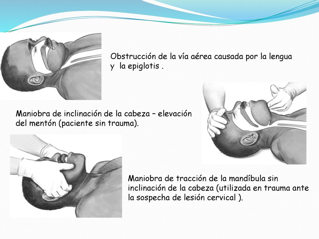 Obstrucción de la vía aérea causada por la lengua y la epiglotis .