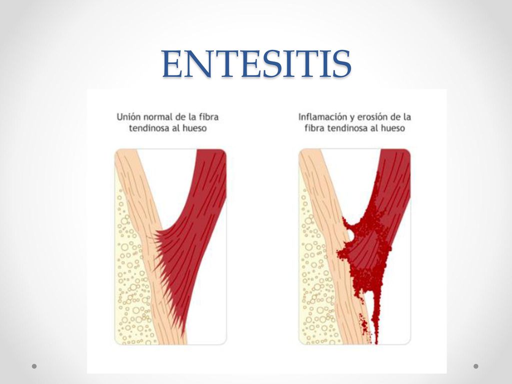 ENTESITIS QUE ES LA ENTESITIS ES LA INFLAMACION DE EL TENDON EN SU INSERCION OSEA.